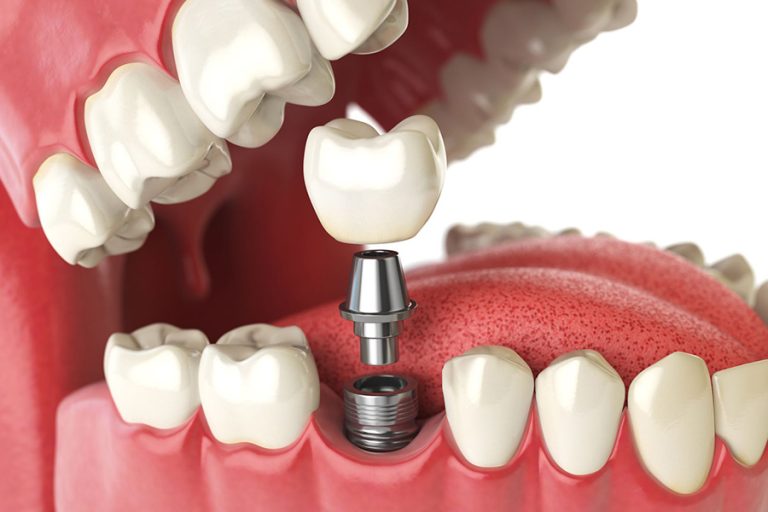 Escáner intraoral 3D